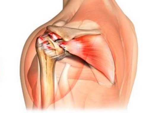 https://arthroscopy.kiev.ua/ua/хвороби-плечового-та-ліктьового-суглоба.html